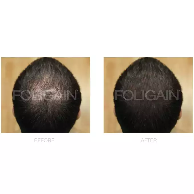 Foligain - Kuracja na porost włosów dla mężczyzn z 5% minoxidil 3x60ml