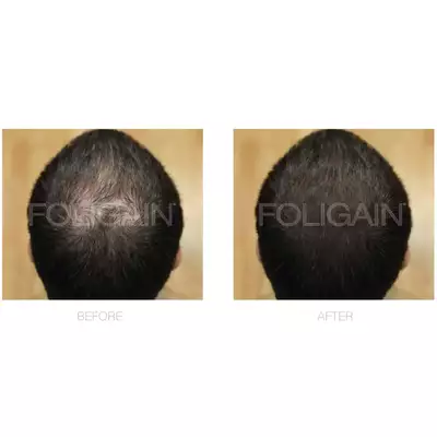 Foligain - Kuracja na porost włosów dla mężczyzn z 5% minoxidil 3x60ml